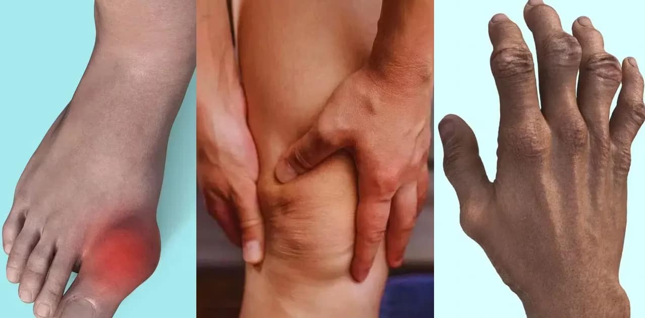 యూరిక్ యాసిడ్